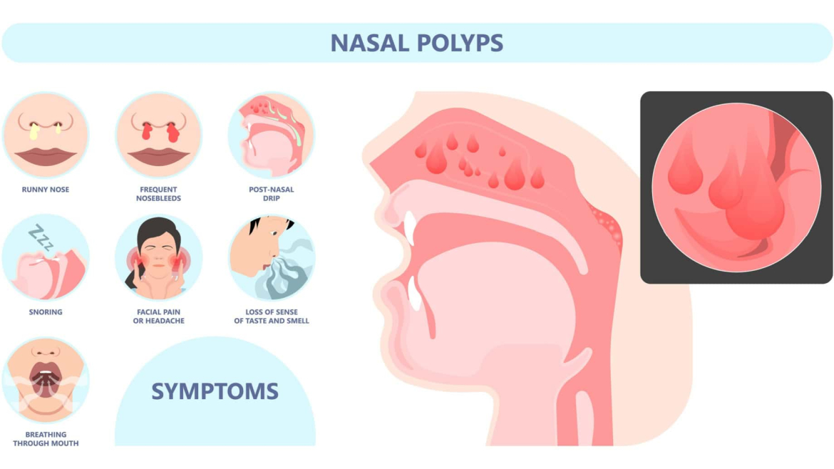 Nasal Polyps