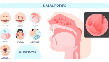 Nasal Polyps
