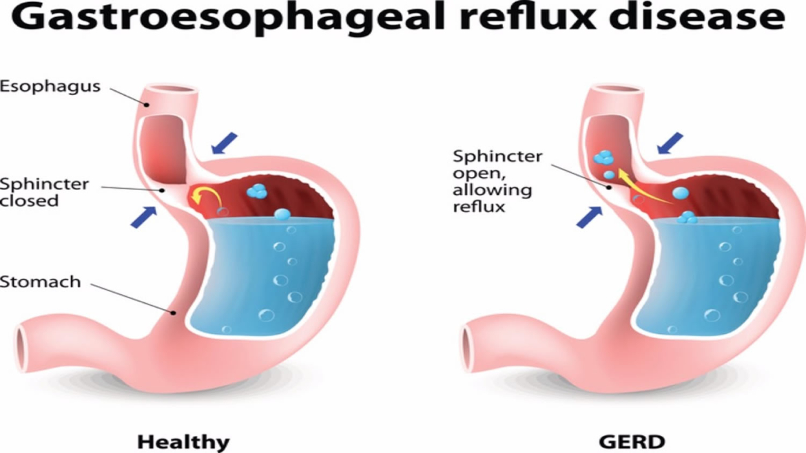 Esophagitis