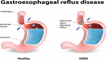 Esophagitis