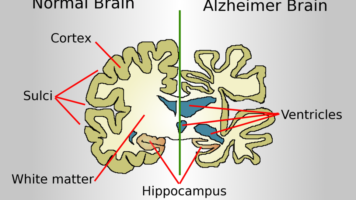 Alzheimer’s Disease