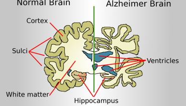 Alzheimer’s Disease